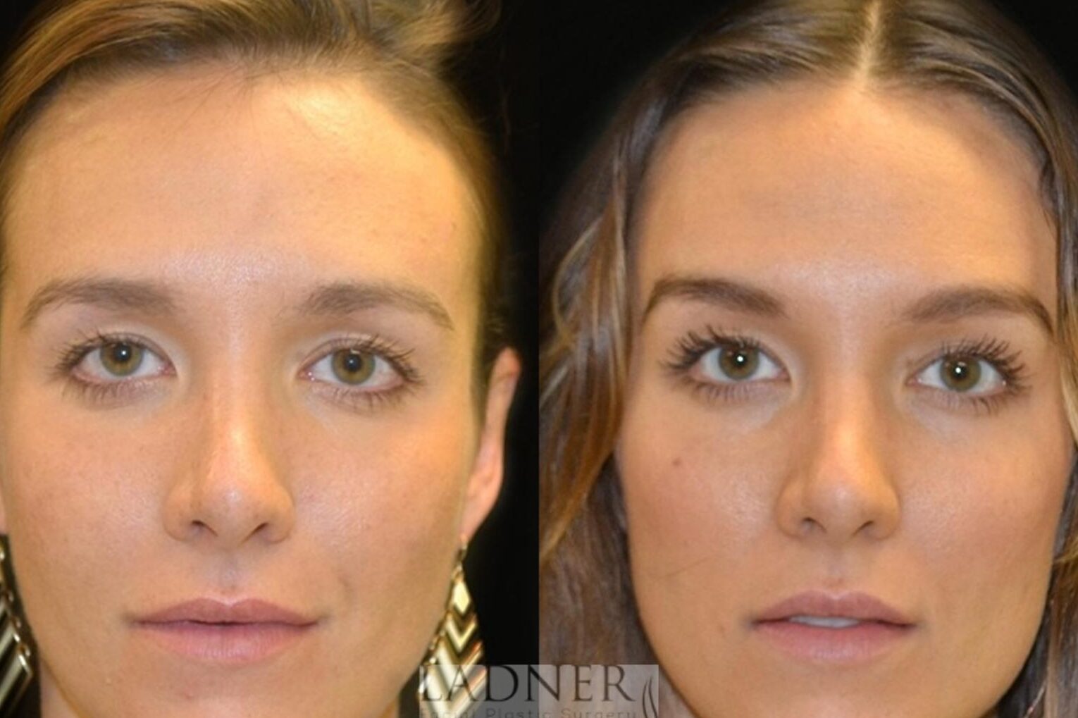 brow lift