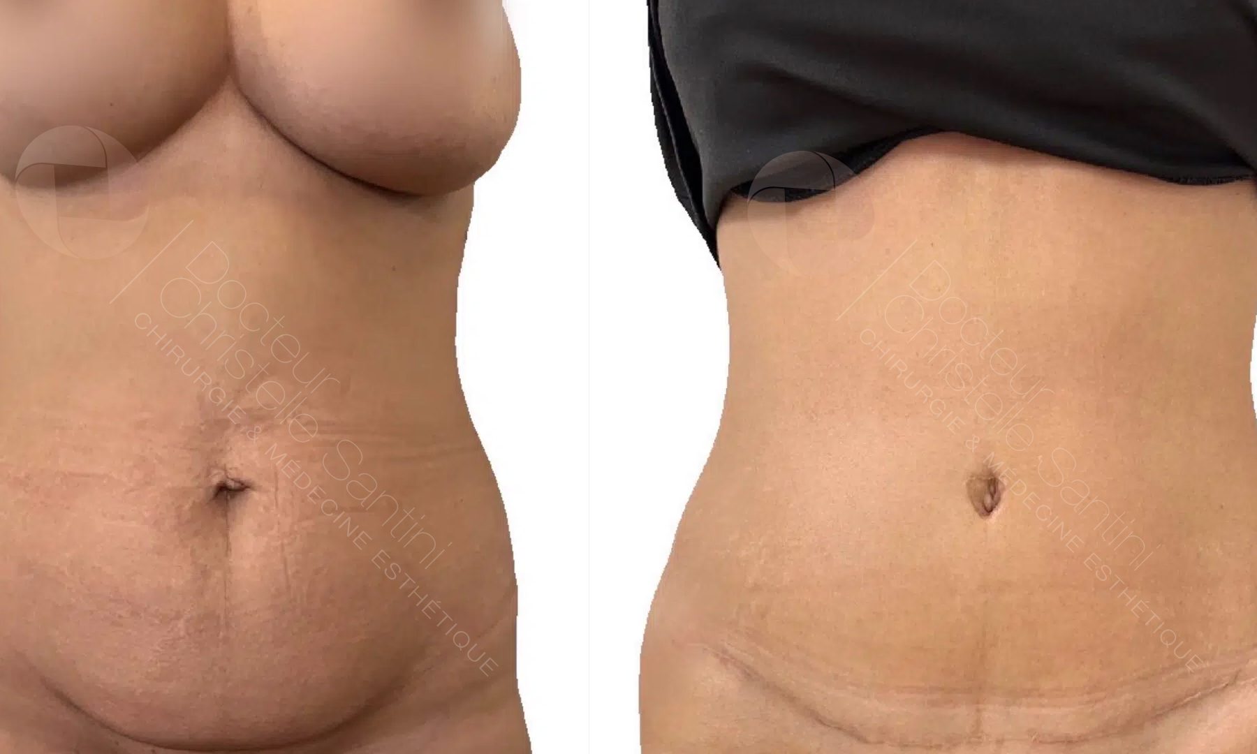 abdominoplastie